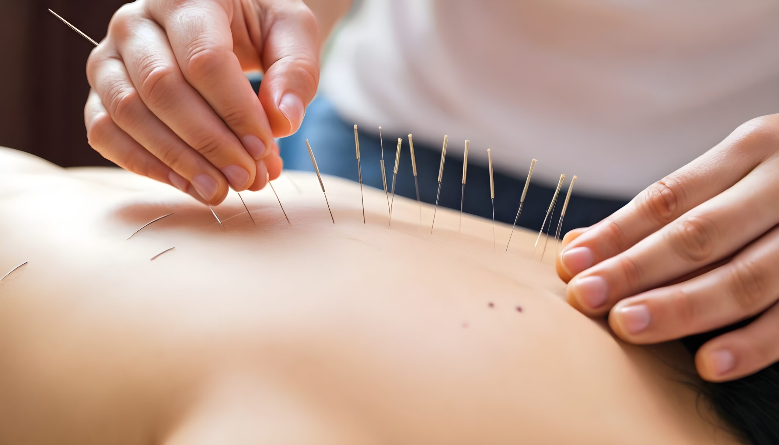 Acupuncture Tips And Tricks Everyone Should Know